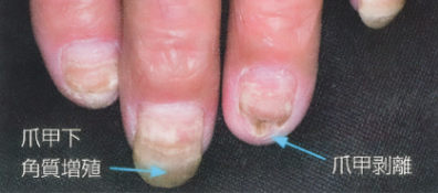 爪カンジダ症