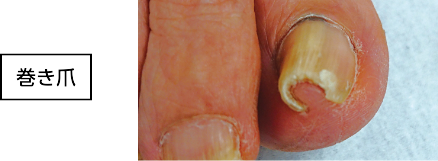 巻き爪