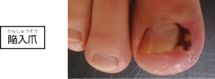 陥入爪