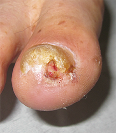 爪白癬から細菌感染を生じて骨髄炎に至っている症例