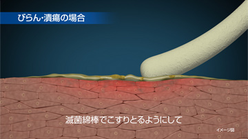 びらん・潰瘍の場合