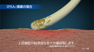 びらん・潰瘍の場合