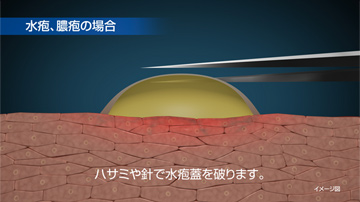 水疱・膿疱の場合