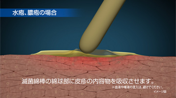 水疱・膿疱の場合