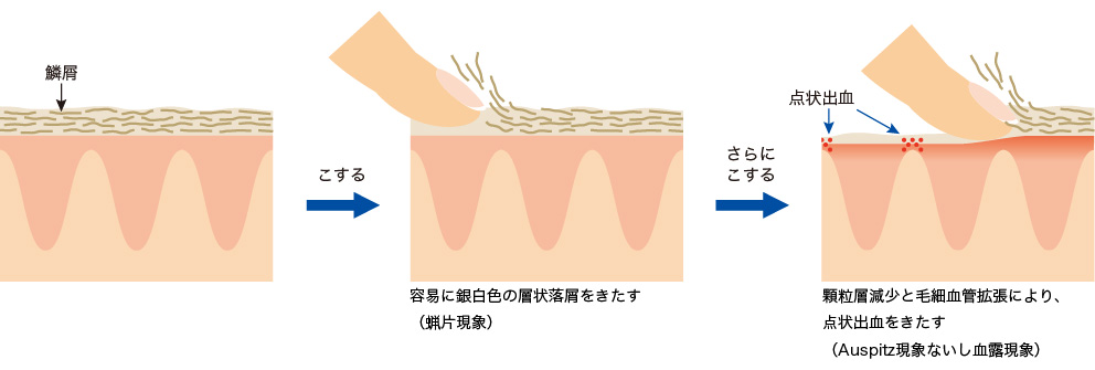 アウスピッツ（Auspitz）現象