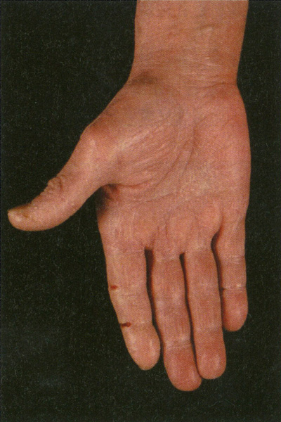 手湿疹