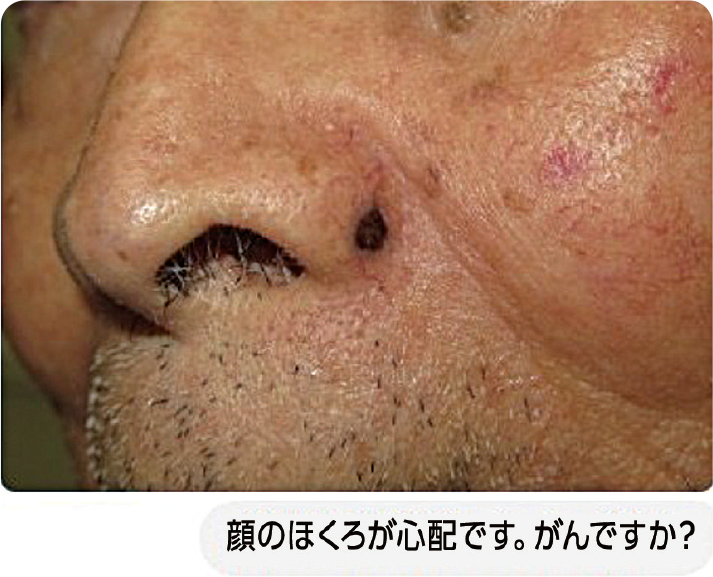 図2. 鼻部の基底細胞がん