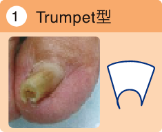 Trumpet型
