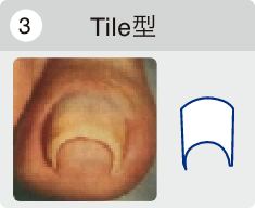 Tile型