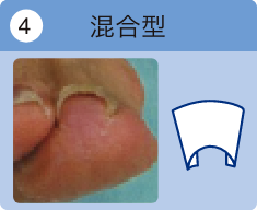 混合型