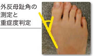 外反母趾角の測定と重症度判定