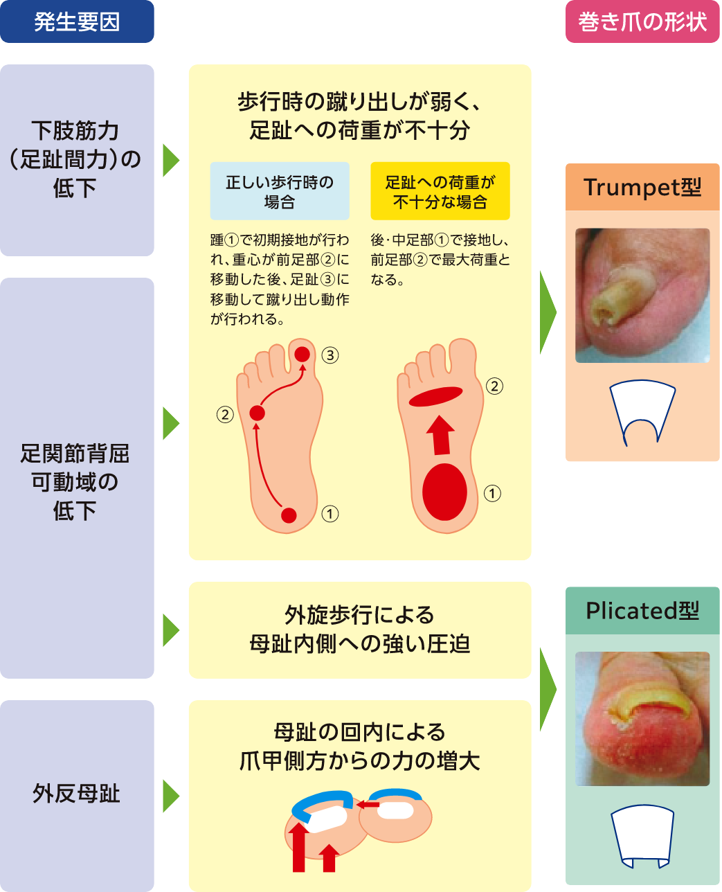 巻き爪形状と発生要因の関連についての考察