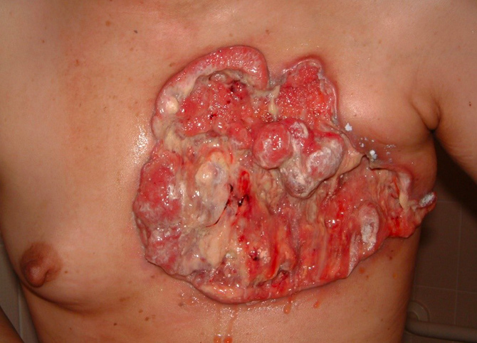 図2：がん性皮膚潰瘍