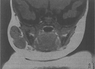 MRI所見（T1強調像）