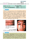口唇ヘルペス カポジ水痘様発疹症