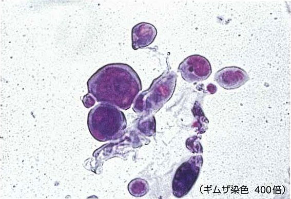 図　ギムザ染色：ウイルス性巨細胞