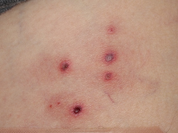 虫さされのように見える帯状疱疹の例