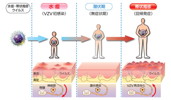 潜伏感染と再活性化