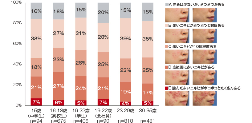 皮膚科に受診する前のニキビの状態