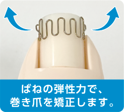 ばねの弾性力で、巻き爪を矯正します。