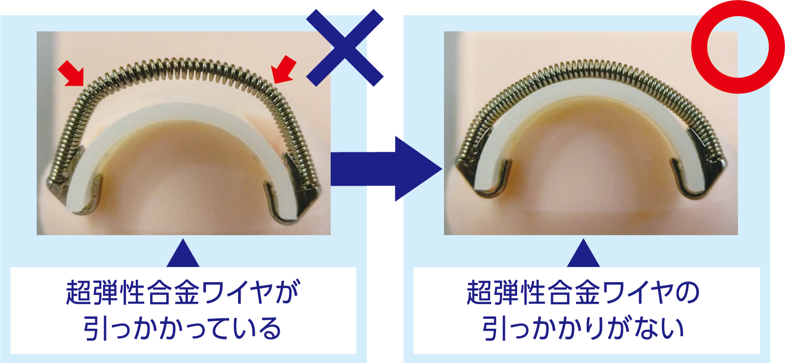 超弾性合金ワイヤの引っかかり