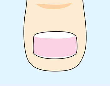 装着に注意が必要な巻き爪