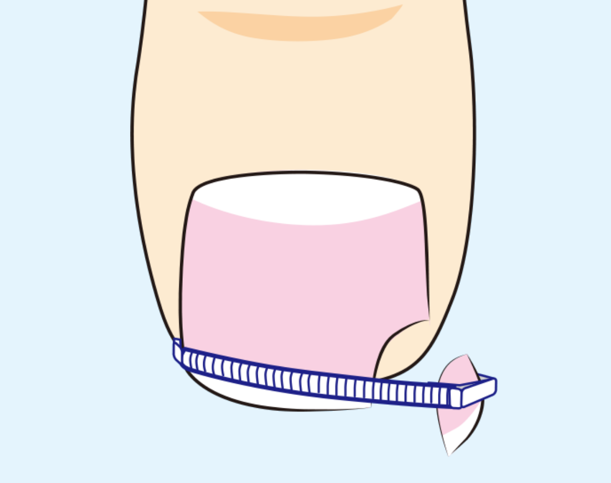 装着に注意が必要な巻き爪