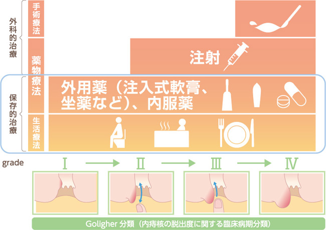 痔の段階的治療法