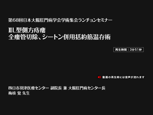 動画サムネイル：ⅡL型側方痔瘻:全瘻管切除、シートン併用括約筋温存術