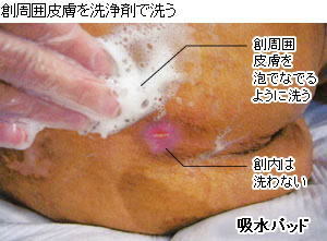 創周囲皮膚の洗浄方法