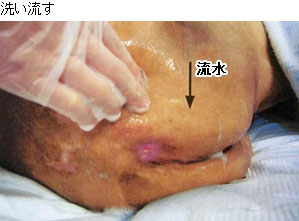 創周囲皮膚の洗浄方法