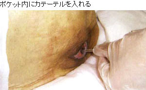 ポケット内の洗浄方法
