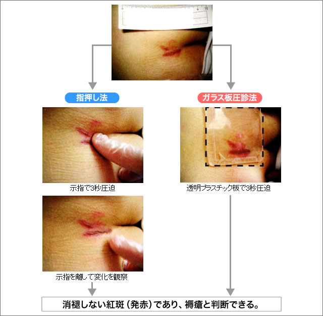 紅斑(発赤)の判定方法 (尾骨部の紅斑<発赤>)