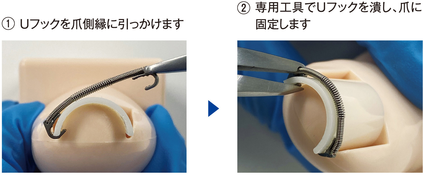 図2:巻き爪マイスターの開発秘話