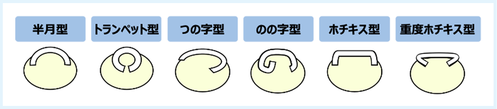 巻き爪の形 回答選択肢