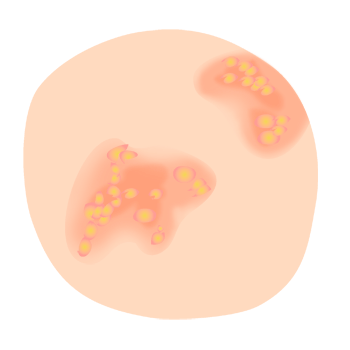 帯状疱疹（水ぶくれ）