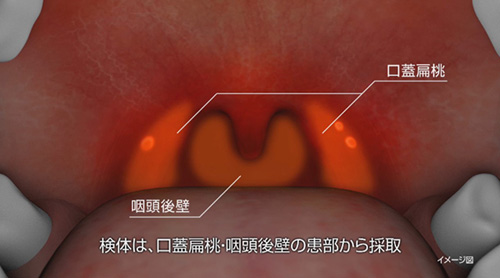 口蓋扁桃