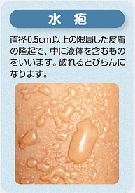 水疱