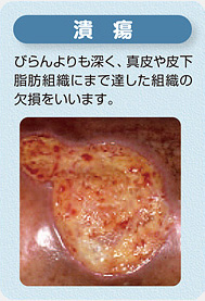 潰瘍