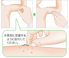 切った本製剤（透明なテープ）を患部に貼付してください。その際、上からしっかりと押さえてください。