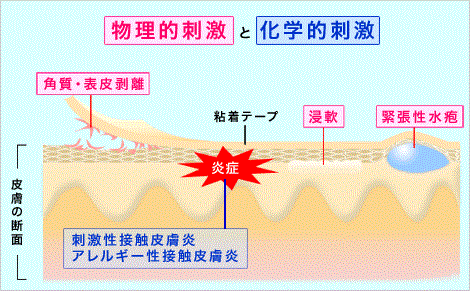 図　テープ剤による皮膚障害とその要因