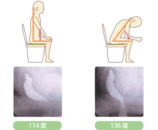 図4. 前傾姿勢で排便が容易になる