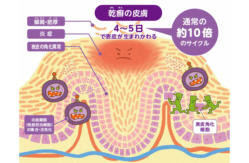 図：乾癬の病態