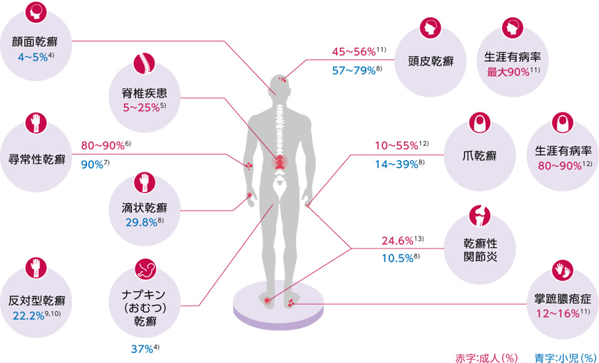 乾癬患者さんにおける臨床症状の有病率