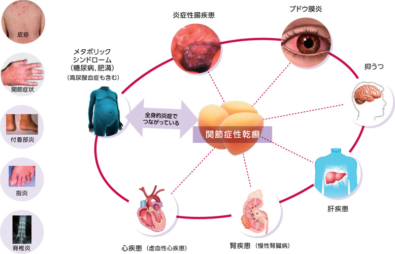 全身疾患としての乾癬“Psoriatic Disease”