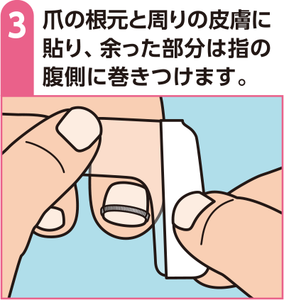 爪の根元と周りの皮膚に貼り、余った部分は指の腹側に巻きつけます。