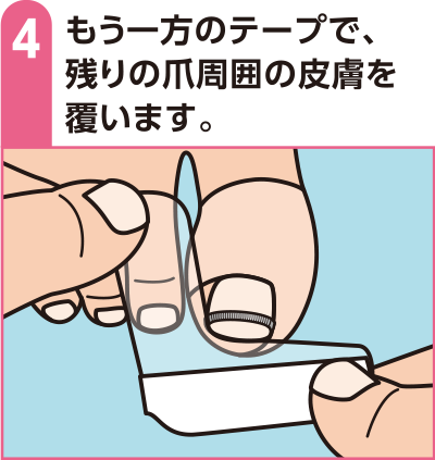 もう一方のテープで、残りの爪周囲の皮膚を覆います。