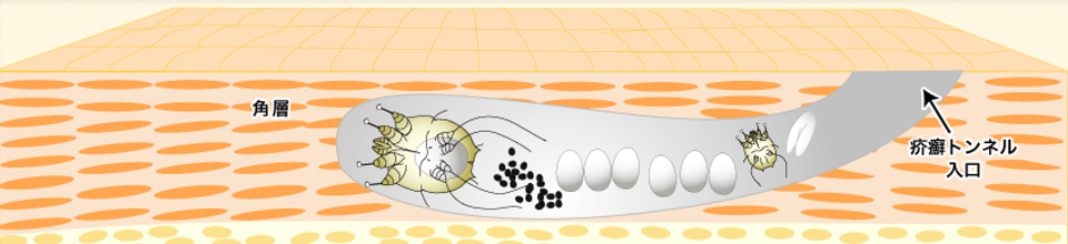 疥癬トンネルイラスト