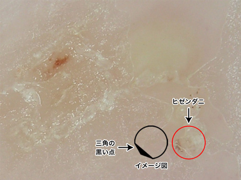 アルコール綿清拭後