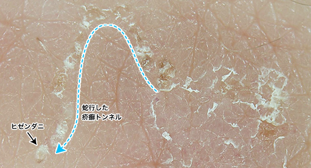 蛇行した疥癬トンネル